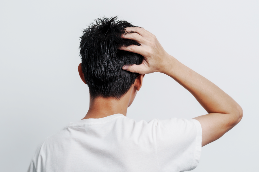 壮年性脱毛症による生え際後退は早めの対策がカギ！勘違いしやすい初期サインと自分に合ったケア方法